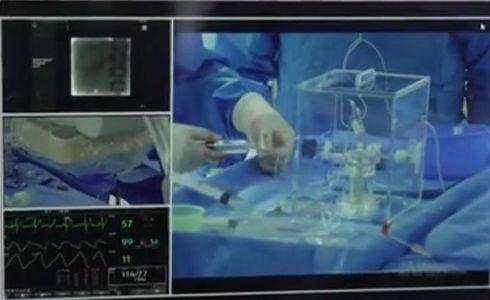 国产钇90微球治疗视频,革新肿瘤治疗新篇章-第1张图片-中文字幕人妻一区