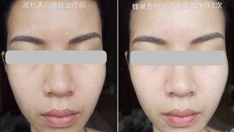 国产超皮秒视频,国产超皮秒技术引领光电美容新潮流-第3张图片-中文字幕人妻一区